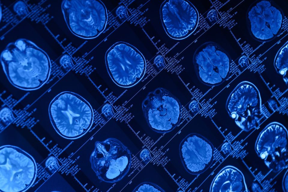 Cévní neurologie a neurosonologie
